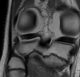 Popliteofibular ligament MRI